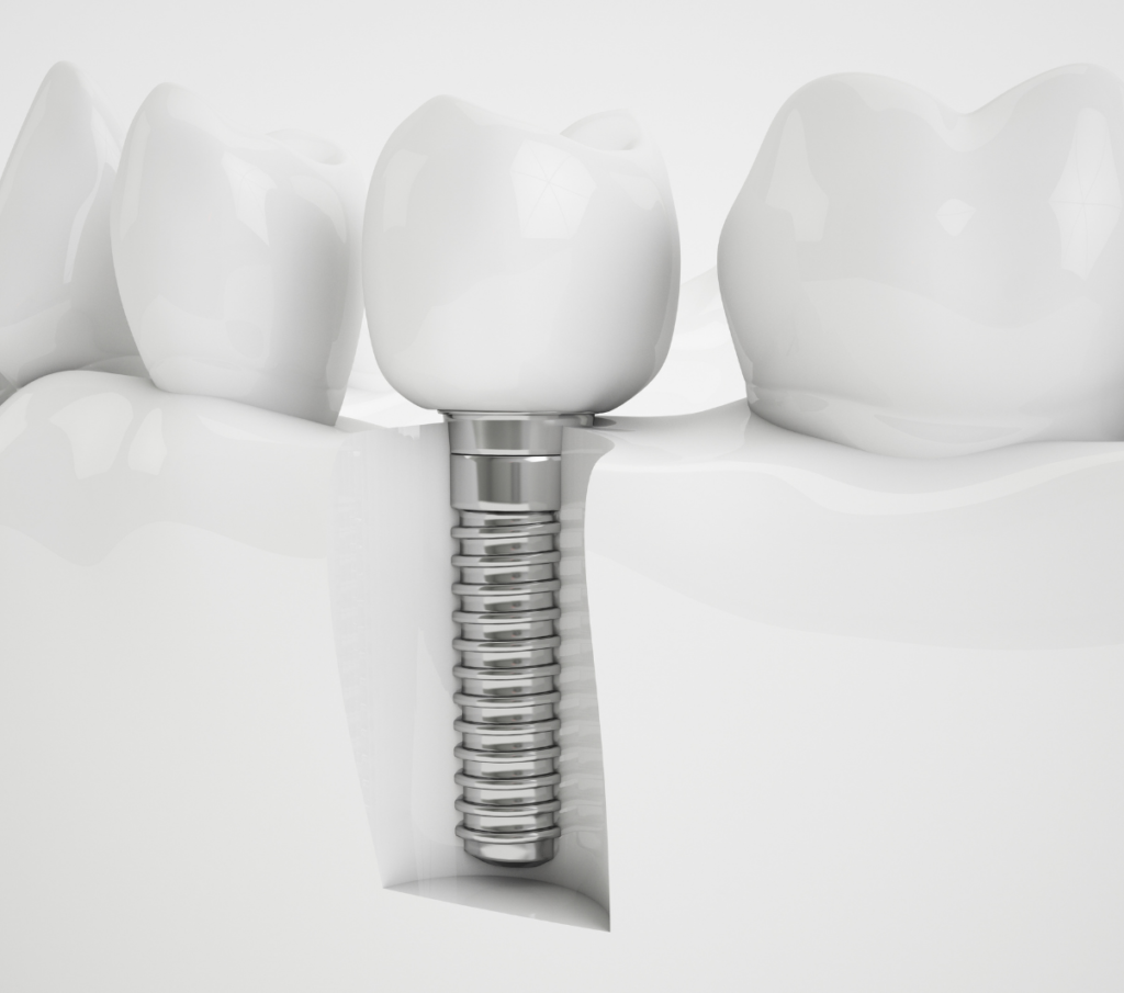 dental implants